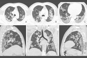 Doctors Puzzle Over COVID-19 Lung Problems